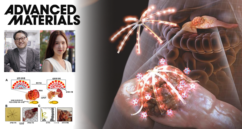 문어 다리처럼 감싸는 3D 마이크로 LED로 췌장암만 정밀 타격